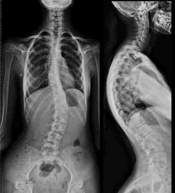 درمان اسکولیوز بدون جراحی